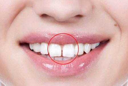 比如牙齿长短不一或者缺角的原因,就会形成