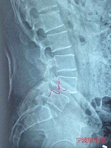 退行性腰椎滑脱症详情与正骨疗法——宁波整脊